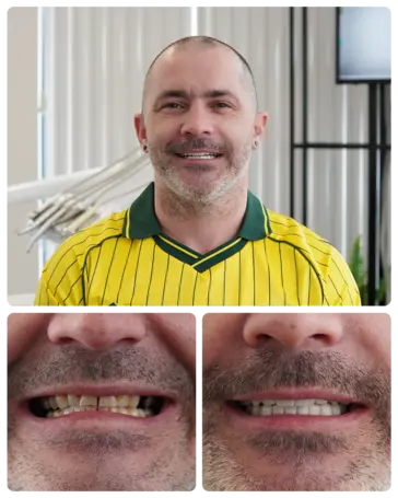 Hollywood Smile transformation — Robert